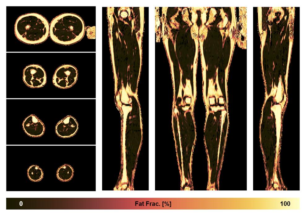 The fat fraction of the lower extremity obtained from the dixon reconstruction for muscle water fat quantification.